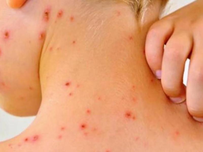 Casos de sarampiÃ³n en AmÃ©rica se han multiplicado: OMS