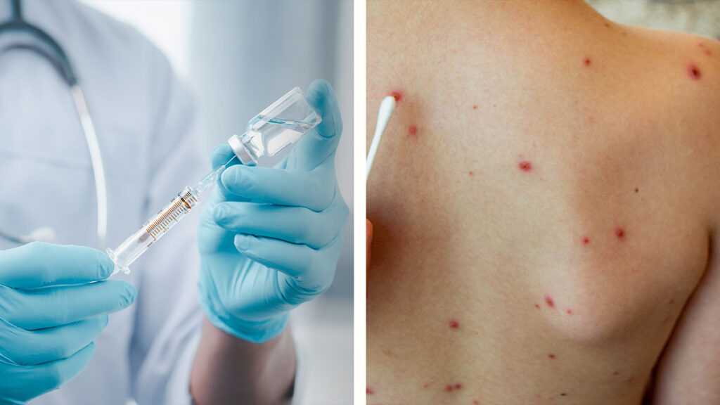 Texas reporta segunda muerte por sarampión